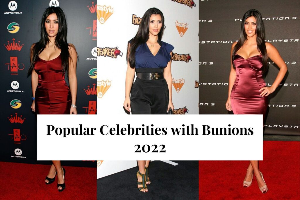 Popular Celebrities with Bunions